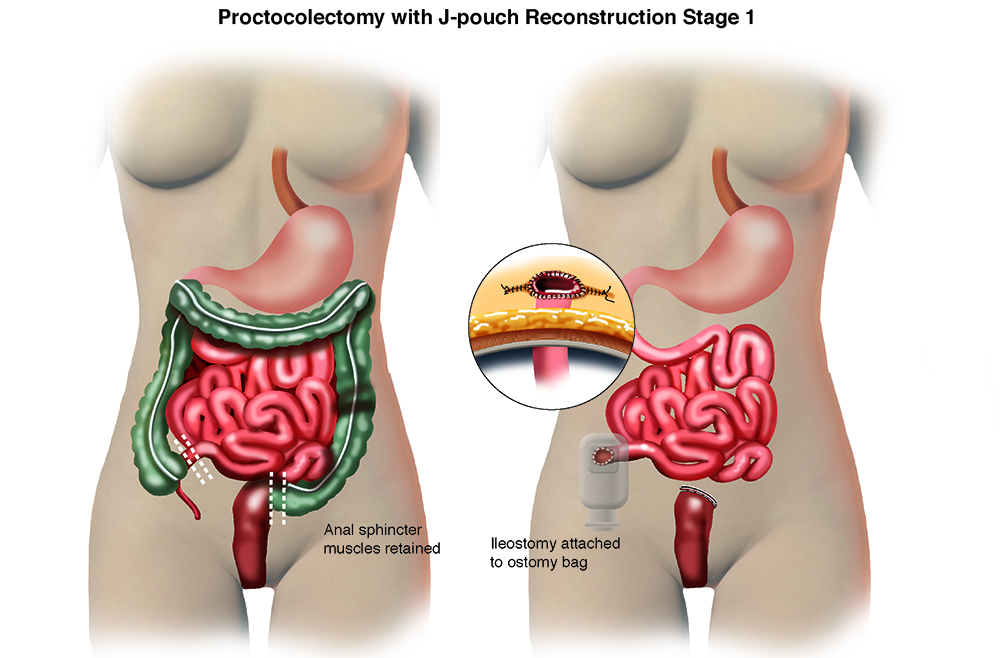 First 2 stages of proctocolectomy surgery